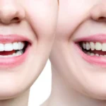 How to Protect Your Smile After a Bonded Tooth Broke at Home