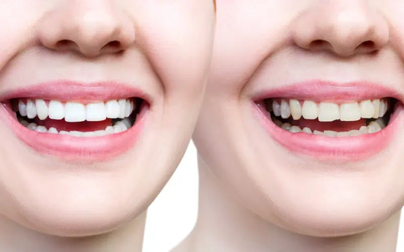 How to Protect Your Smile After a Bonded Tooth Broke at Home